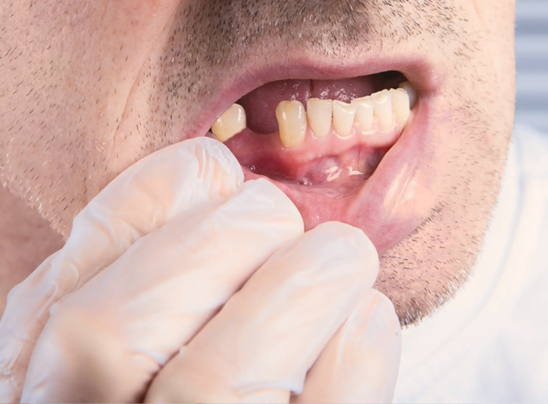 Dents absentes