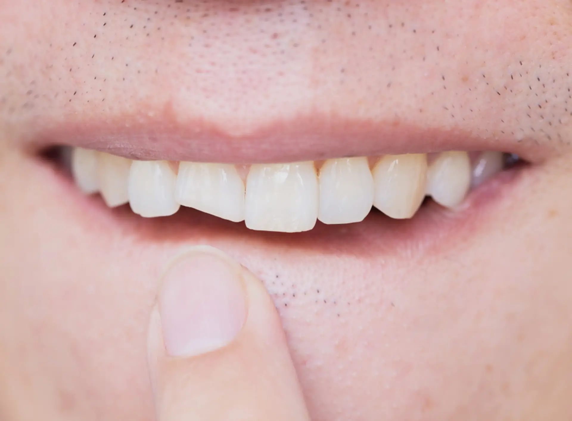 Dents cassées