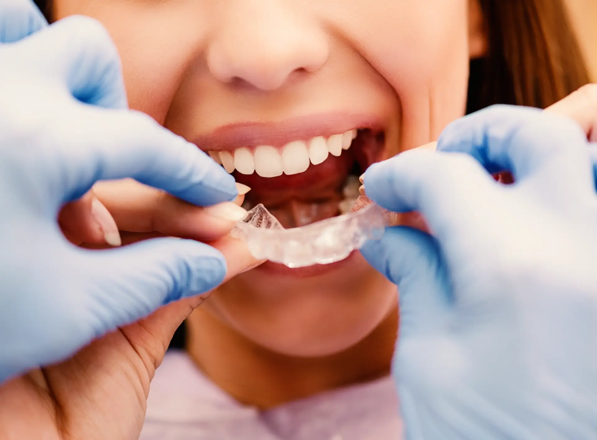 Orthodontie Invisible