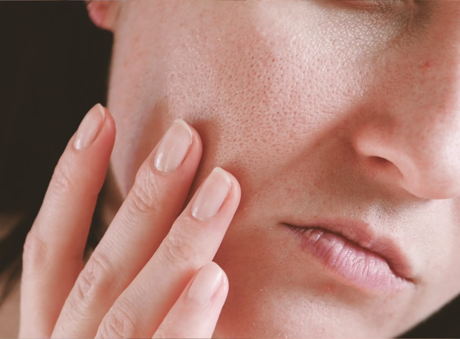 Pores dilatés – acné et cicatrice d’acnée