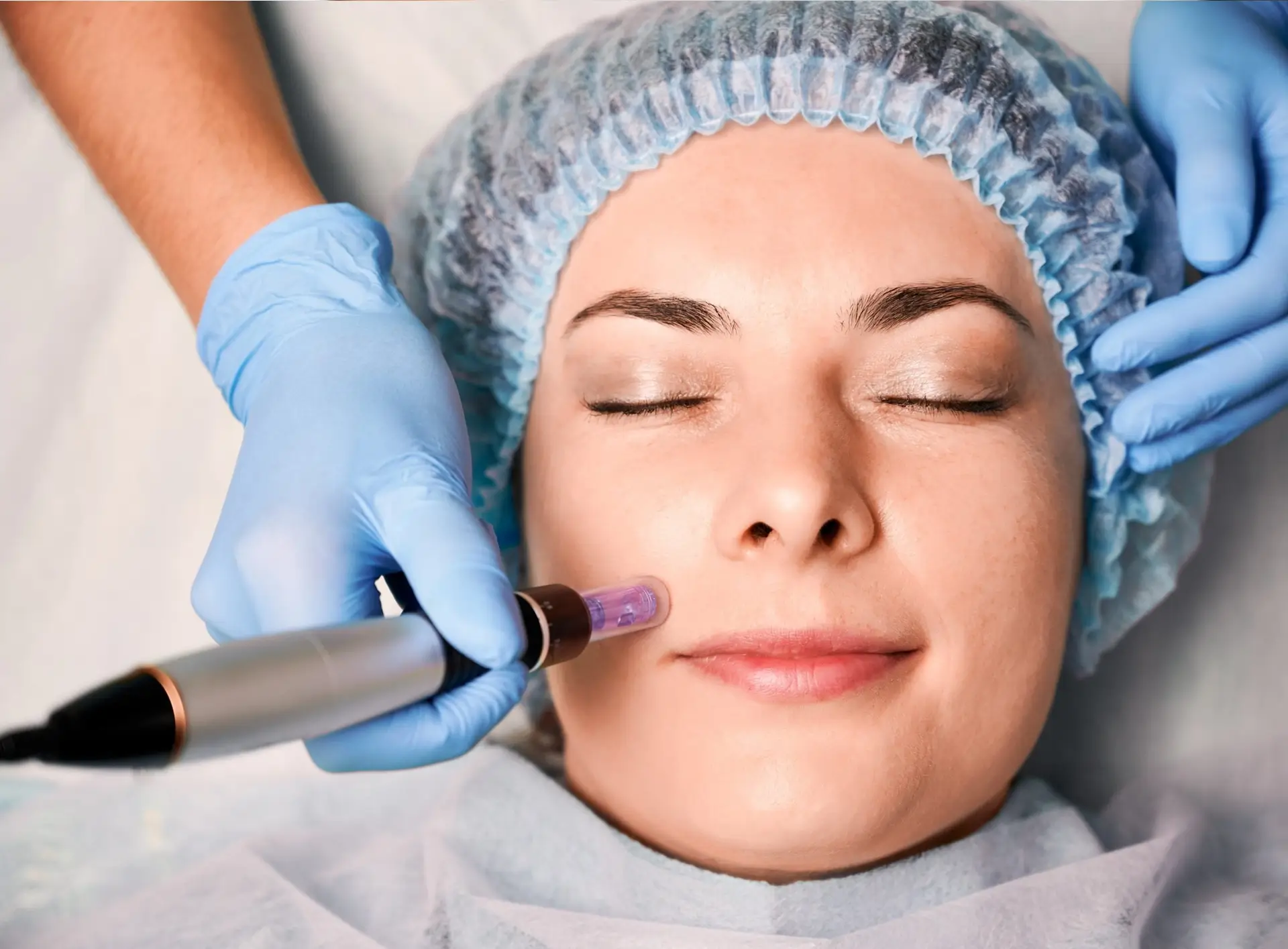 Microneedling